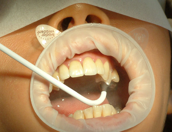 Zabiegi stomatologiczne wykonywane w narkozie